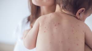 Focus on controlling measles continues in the Bay of Plenty